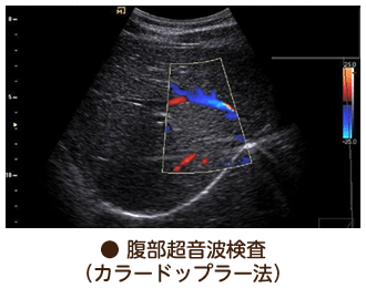 腹部超音波検査（カラードップラー法）