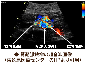 腎動脈狭窄の超音波画像（東徳島医療センターのHPより引用）